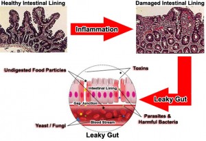 leaky gut cure